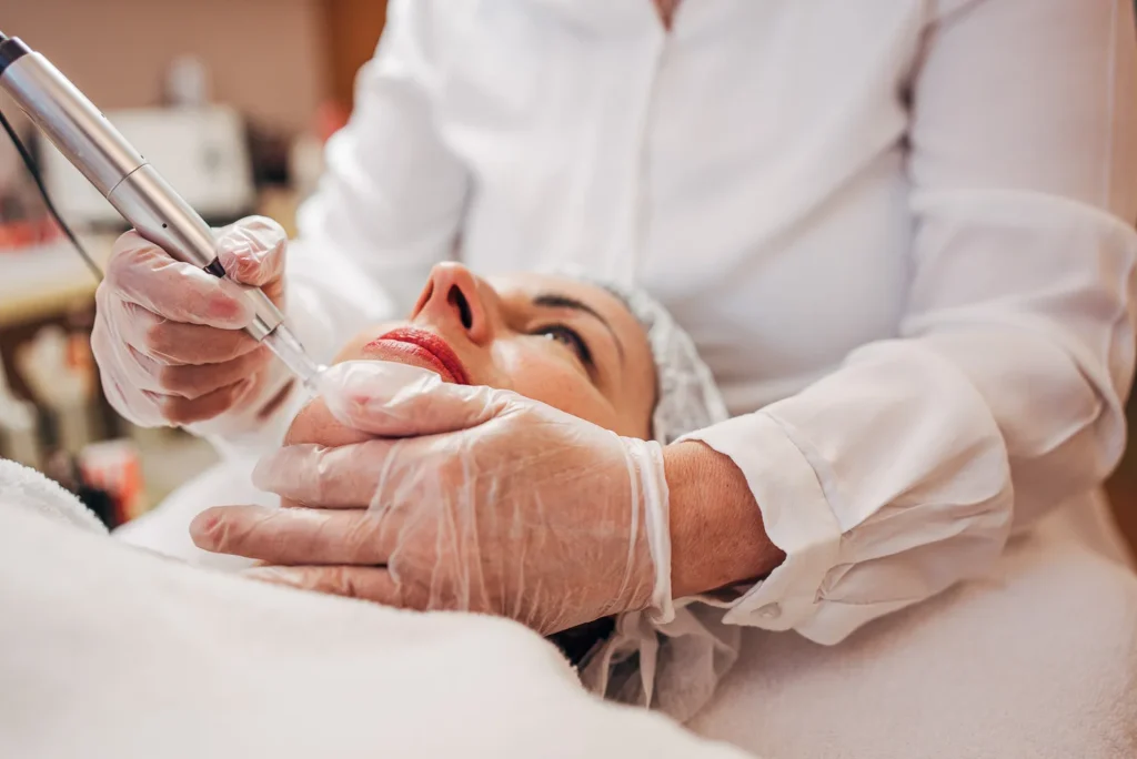 Microneedling-Behandlung für feineres Hautbild im Kosmetikstudio Augsburg