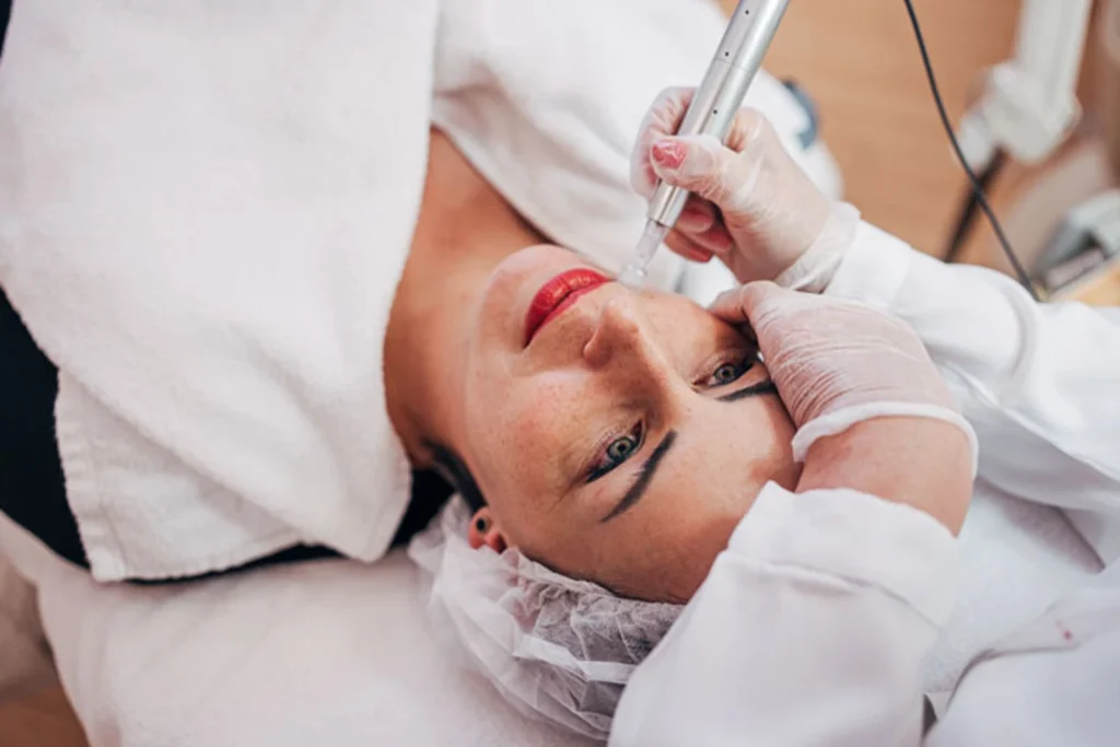 Microneedling-Behandlung in Augsburg – Hautverjüngung