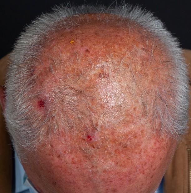 Kopfhaut mit sichtbaren UV-Schäden durch jahrelange Sonneneinstrahlung ohne Schutz