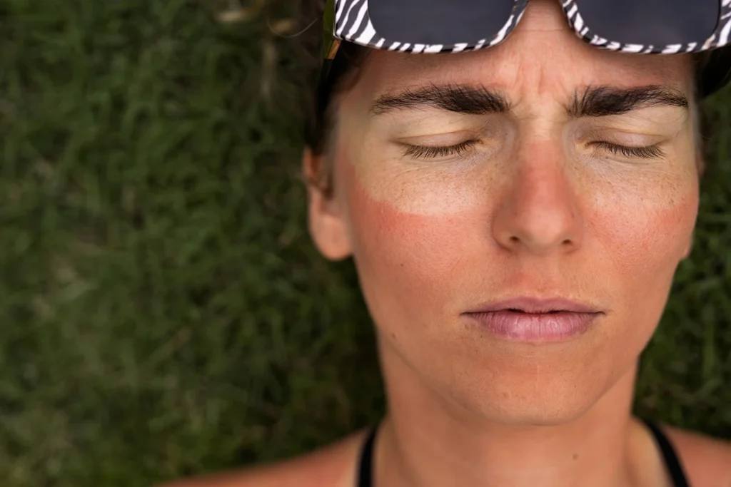 Frau mit starkem Sonnenbrand im Gesicht und geschlossenen Augen – Notwendigkeit von Sonnenschutz.